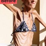 ST5. The World’s Thinnest Woman’s Battle Against Anorexia Will Leave You Speechless! S2