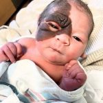 HT7. Mom on a mission to show daughter with extremely rare birthmark that she is beautiful